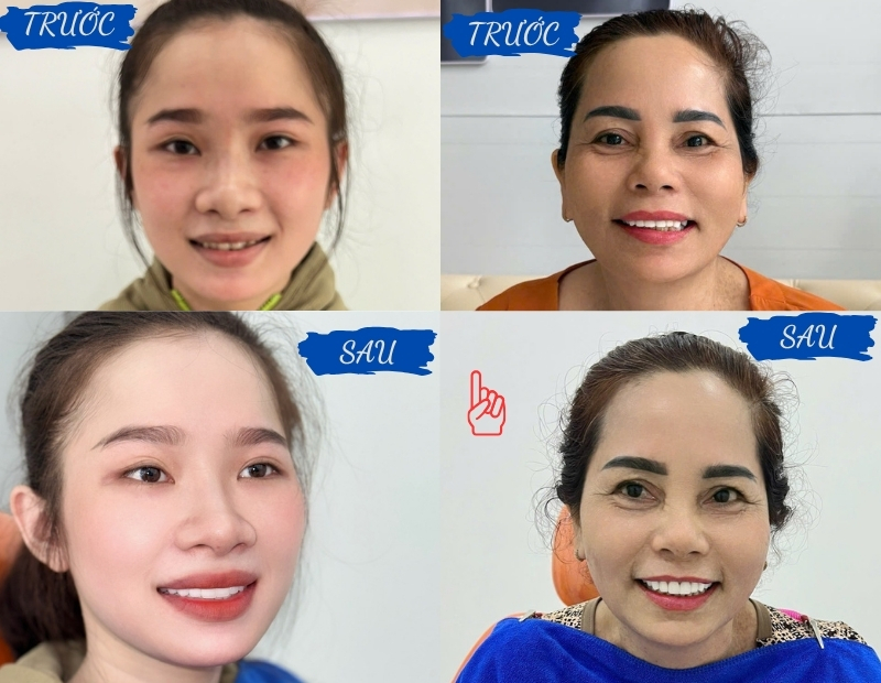 RĂNG SỨ THẨM MỸ  