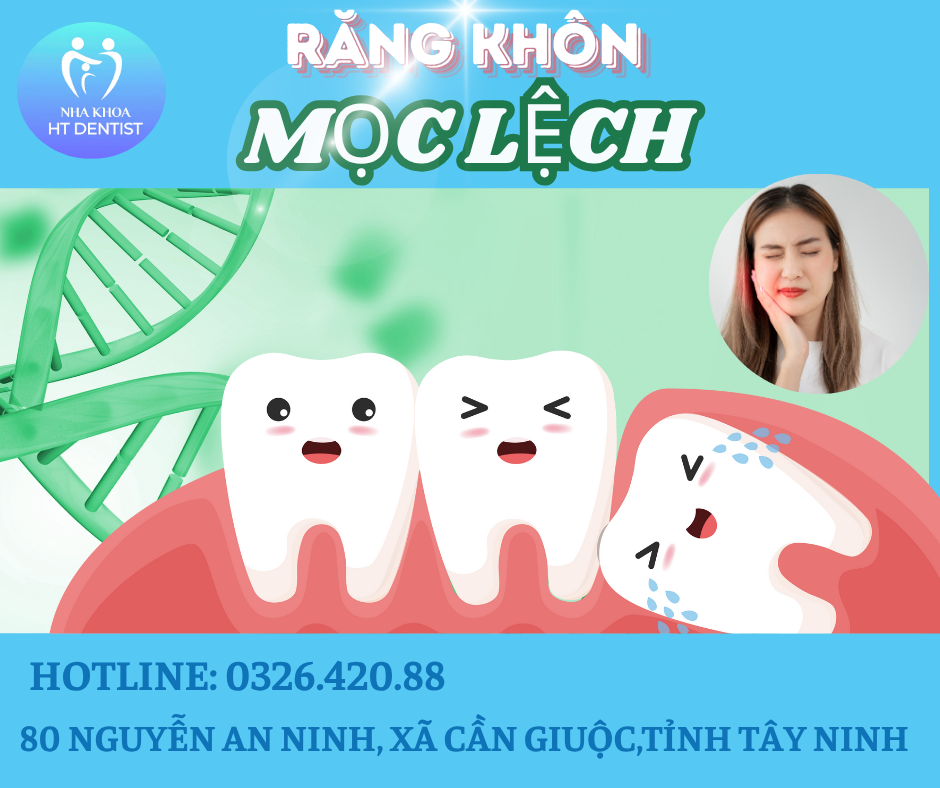 Nhổ răng khôn