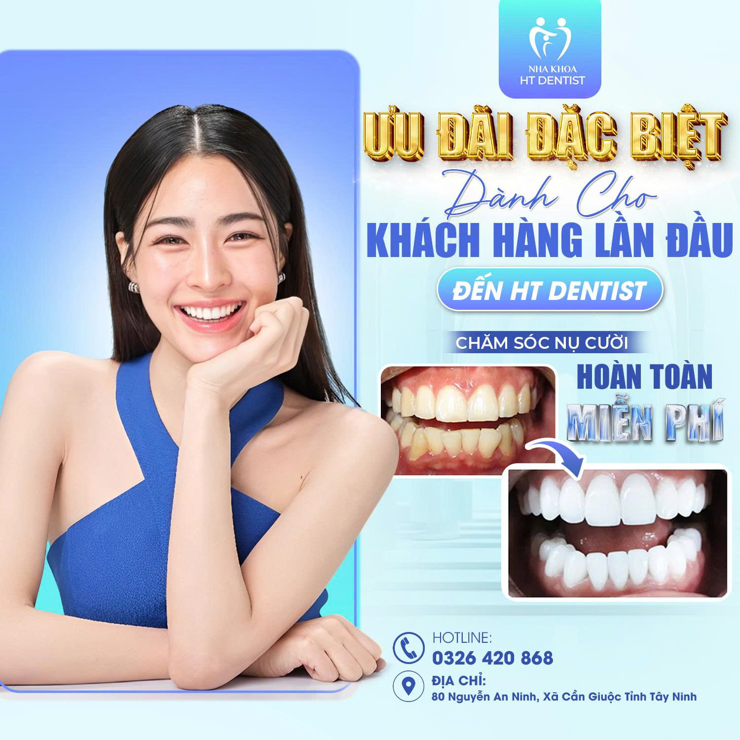 Dán sứ Veneer