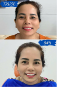 Răng Sứ Thẩm Mỹ